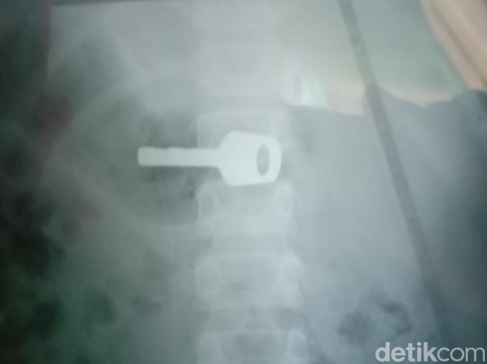 Zul (9) dan penampakan kunci yang tak sengaja ia telan di Indramayu