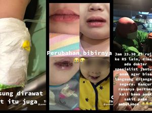 Kronologi Viral Balita Kena Penyakit Langka Kawasaki Tak Ditanggung BPJS