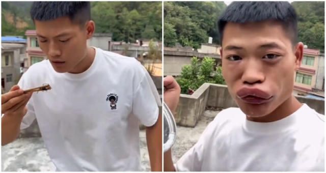Sengaja Makan Lebah Agar Bibirnya Seksi, Influencer China Ini Dikecam