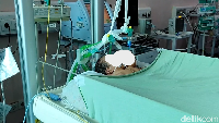Bayi kembar siam satu tubuh dua kepala itu sendiri lahir di RSUD dr. Sadikin Kota Pariaman, Sumatera Barat pada Rabu (21/9/2022) pagi. (Jeka/detikSumut)