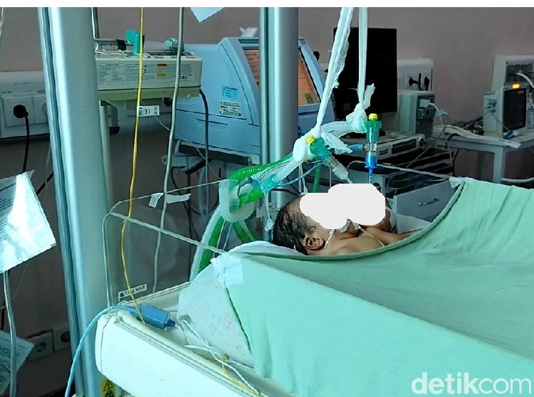 Potret Bayi Kembar Siam Lahir dengan 2 Kepala 1 Badan di Pariaman