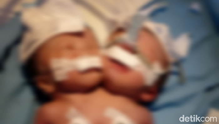 Bayi kembar siam dua kepala satu badan lahir di Pariaman, Sumbar.