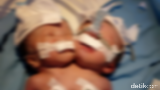 Bayi Kembar Siam Lahir di Pariaman, 2 Kepala 1 Badan