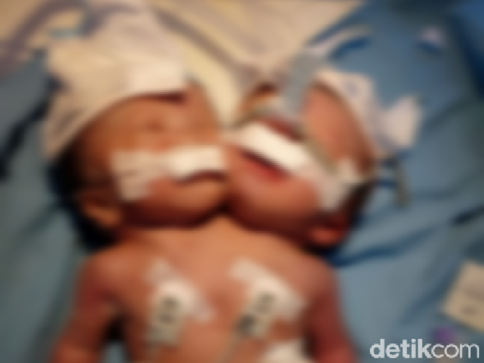 Bayi kembar siam dua kepala satu badan lahir di Pariaman, Sumbar.