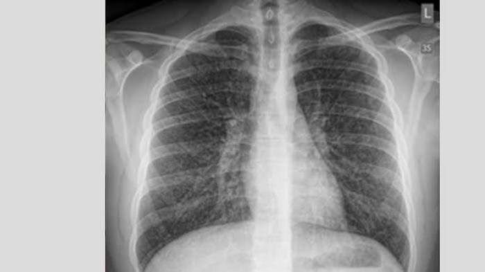 popcorn lung popcorn lung