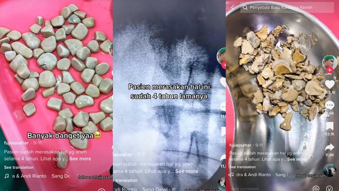 Viral batu kandung kemih Viral pasien memiliki batu kandung kemih