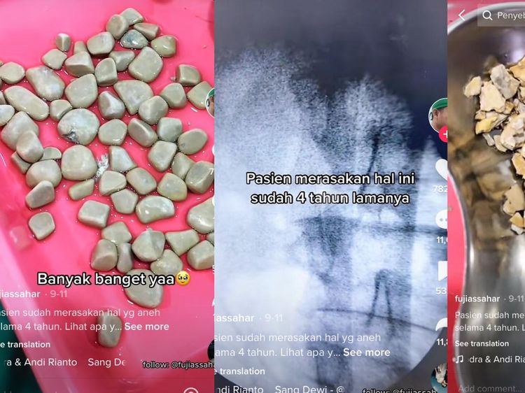 Penampakan Batu Kandung Kemih yang Mengendap Selama 4 Tahun, Inikah Penyebabnya?