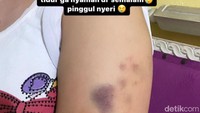 Brigadir Ira dan Ibunya Yulia sudah menjadi tersangka atas kasus penganiayaan terhadap Riri. Tidak terima Brigadir Ira melaporkan balik Riri ke Polda Riau atas tuduhan pelanggaran ITE. (Foto: Istimewa/tangkapan layar)