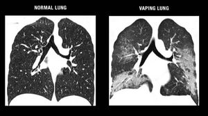 Yakin Nggak Mau Tobat Ngevape? Ini Penampakan Paru-paru Sehat Vs Vapers