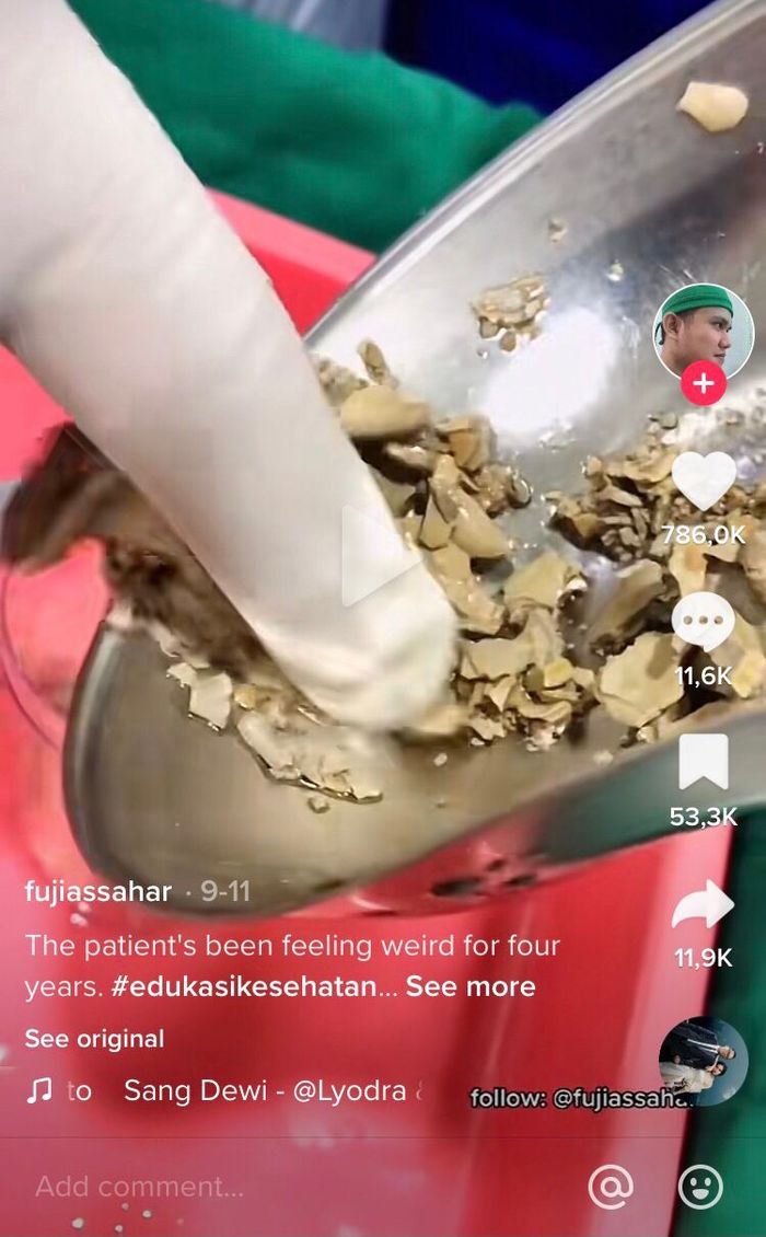 Viral batu kandung kemih Viral batu kandung kemih.