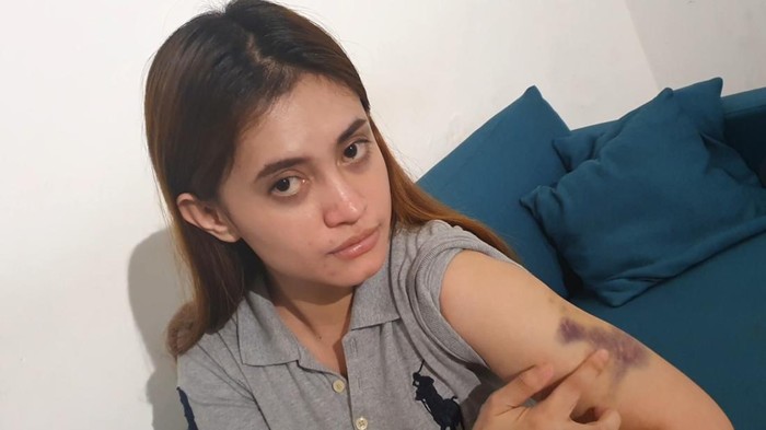 Riri Aprilia Kartin (27) menunjukkan memar akibat dugaan penganiayaan oleh Polwan di Pekanbaru. Raja Siregar/detikSumut
