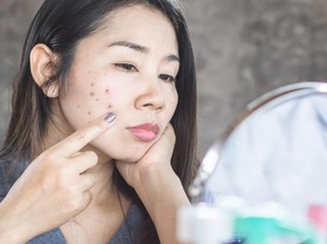 7 Cara Menghilangkan Flek Hitam Membandel di Pipi Secara Alami