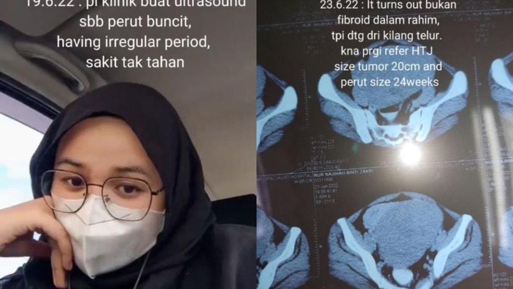 Viral Kisah Wanita 22 Tahun Punya Tumor 2 Kg di Rahim, Buncit bak Hamil