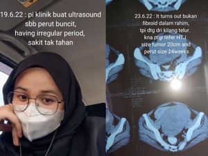 Kronologi Gadis 22 Tahun Punya Tumor 2 Kg di Rahim, Buncit Bak Hamil 24 Minggu