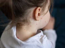 Dinkes Palembang Ingatkan Warga Antisipasi Penyakit Campak