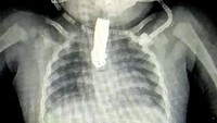 Pemeriksaan sinar-X menunjukan gunting kuku sepanjang 5 cm itu tersangkut dan menutupi hampir seluruh tenggorokan. (Foto: Newslion/SWNS)