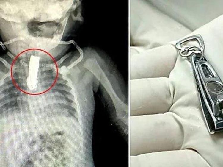 Ngilu! Potret Operasi Dijalani Bayi 8 Bulan Akibat Telan Gunting Kuku