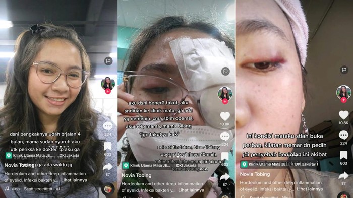 Viral Wanita Jakut Bintitan Sampai Harus Operasi, Ternyata Kena Penyakit Ini