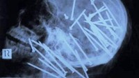 Hobi makan paku, hasil pemeriksaan sinar x-ray milik pasien yang satu ini bikin ngeri. Hampir seluruh bagian kepala dan tenggorokannya dipenuhi oleh paku besar yang tajam. Foto: Pool/Site