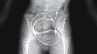 Kalau yang ini benar-benar bikin ngeri. Ular panjang yang masih hidup berhasil masuk ke dalam tubuh pasien yang satu ini! Foto: Pool/Site