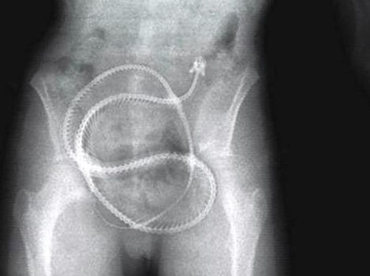 10 Penemuan Benda Aneh di Perut Manusia, Ada Paku hingga Ular