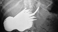 Sendok dan garpu jadi salah satu benda yang paling sering tertelan lewat tenggorokan. Tapi hasil pemeriksaan x-ray yang satu ini tunjukkan belasan sendok dan garpu yang berada di dalam perut manusia. Foto: Pool/Site