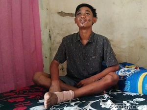 Kondisi Saguwanto Korban Tragedi Kanjuruhan: Kaki Patah-Wajah Melepuh
