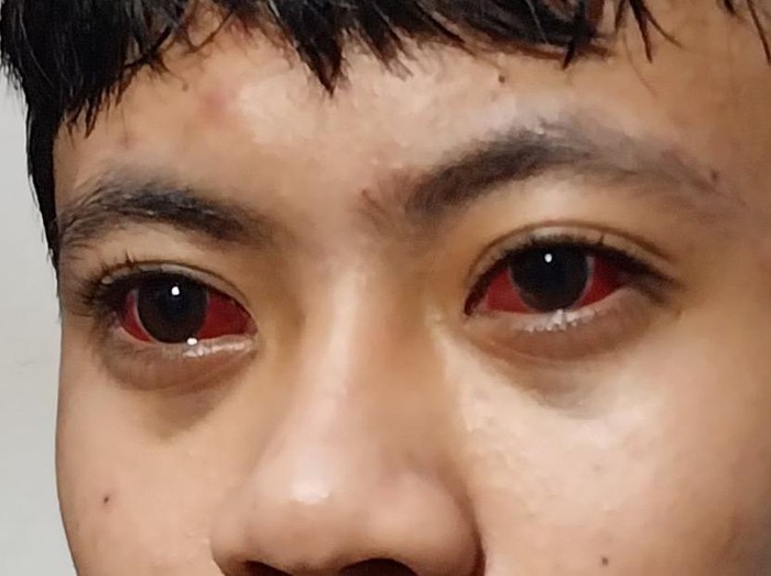 korban kanjuruhan malang matanya merah terkena gas air mata