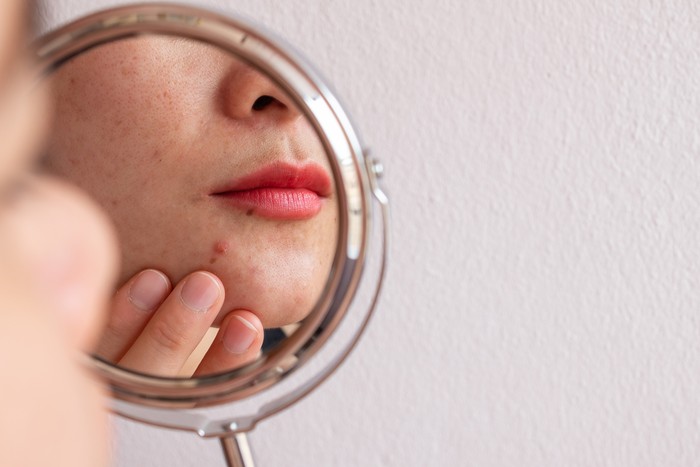 Ilustrasi Skincare Jerawat Ilustrasi Skincare Jerawat