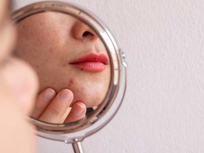 Ilustrasi Skincare Jerawat