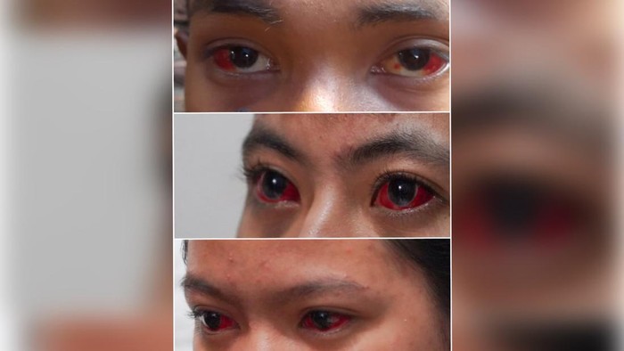 Viral unggahan yang menyebut adanya korban kanjuruhan mengalami mata merah selama lebih dari seminggu.