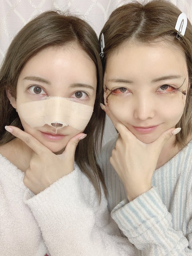 Di media sosial Twitter, Chie dan Chika bahkan tidak segan memperlihatkan wajah lebam mereka sesaat setelah operasi plastik. Foto: Twitter