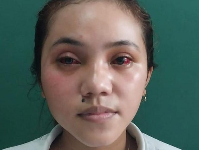 Kevia Naswa korban luka kanjuruhan malang