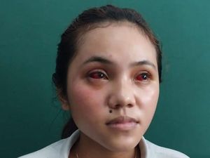 7 Fakta Mahasiswi Widyagama Mata-Wajah Merah Kena Gas Air Mata Kedaluwarsa