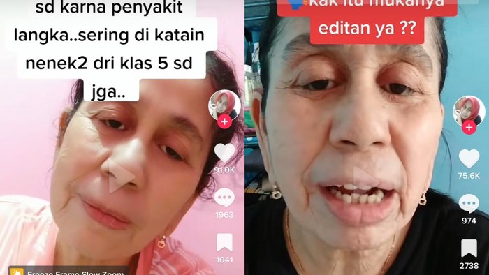 Viral Wanita di Bekasi Mengaku Idap Progeria, Sejak SD Sudah Seperti Nenek-nenek