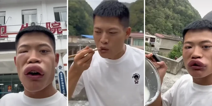 Demi Viral, Orang Ini Rela Makan Laba-laba hingga Lebah Sampai Wajah Bengkak