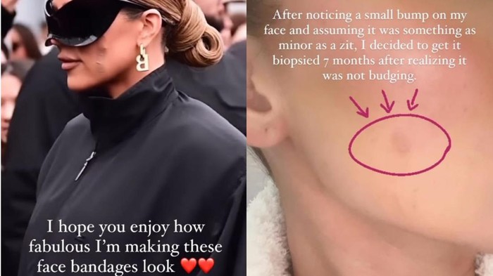 Khloe Kardashian idap kanker kulit