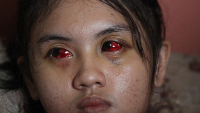 Suporter Arema FC (Aremania), Kevia Naswa Ainur Rohma menunjukkan matanya yang masih memerah akibat menjadi salah satu korban luka di Tragedi Kanjuruhan di Kedungkandang, Malang, Jawa Timur, Rabu (12/10/2022). Kevia adalah salah satu dari 737 korban luka yang saat terjadinya tragedi Kanjuruhan berada di tribun 12 dan terkena gas air mata serta terinjak-injak penonton lain.  ANTARA FOTO/Ari Bowo Sucipto/wsj.
