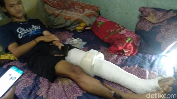 Bagas korban Tragedi Kanjuruhan mengalami patah tulang