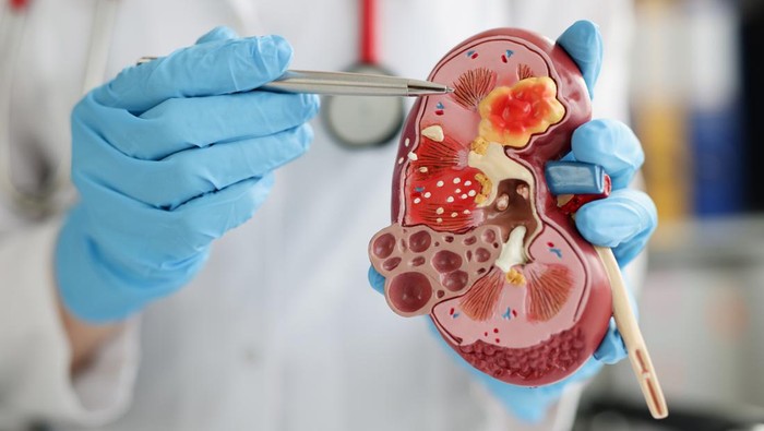 Ilustrasi Penyebab Gagal Ginjal Akut dan Cara Mencegahnya Close-up of urologist pointing pen kidney structure on anatomical model. Treatment of kidney diseases, pyelonephritis