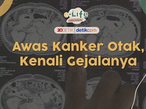 Sakit Kepala karena Kanker Otak, Apa Bedanya? Ini Penjelasan Dokter