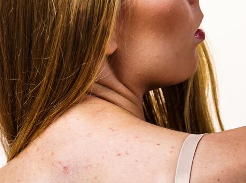 Penyebab Jerawat di Punggung