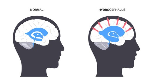 Hidrosefalus