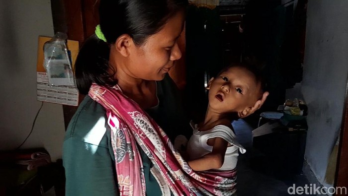 Balita di Brebes sangat kurus dan cuma berbobot 5 kg. Keluarganya tak punya biaya berobat. Foto diambil Senin (31/10/2022).
