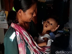 Tolong! Balita di Brebes Ini Sangat Kurus, Butuh Biaya Berobat