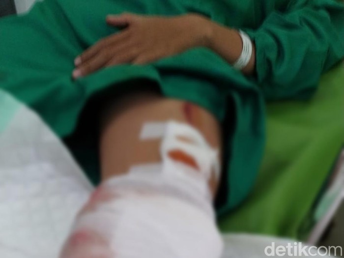 Kaki Herlin robek dan harus dijahit usai menendang penjambret dompetnya