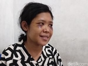 Polisi Ungkap Kondisi ART Rohimah Terkini Usai Disiksa Majikan