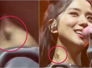Jisoo BLACKPINK Ada Benjolan di Leher Sampai Diduga Kena Tumor, Apa Penyebabnya?