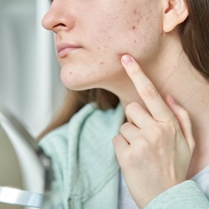 5 Cara Menghilangkan Jerawat Batu, Pakai Skincare Berbahan Ini