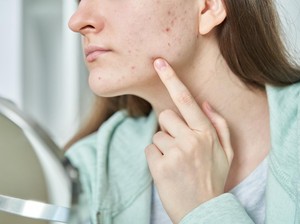 5 Cara Menghilangkan Jerawat Batu, Pakai Skincare Berbahan Ini